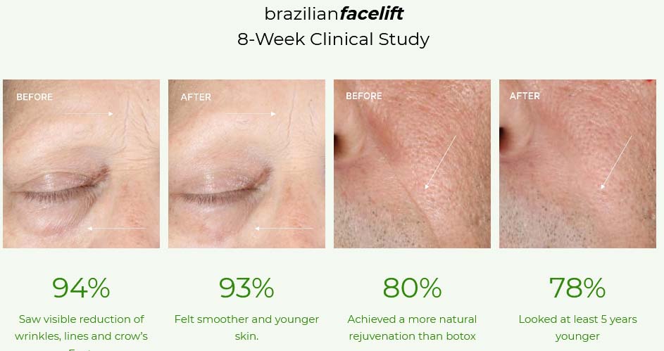 Brazilian facelift kit